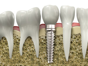 Dental implant